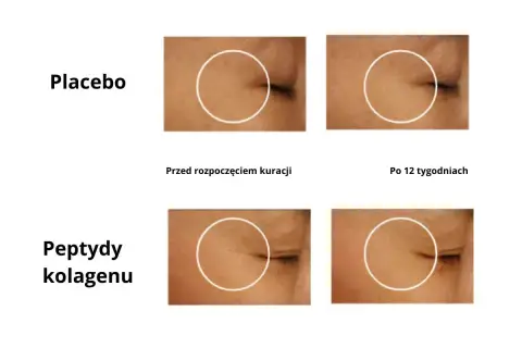 Porównanie skóry przed i po 12 tygodniach. Grupa placebo bez zmian, grupa z peptydami kolagenu wykazuje redukcję zmarszczek, co może być oznaką, że nadmiar kolagenu objawy nie są widoczne.