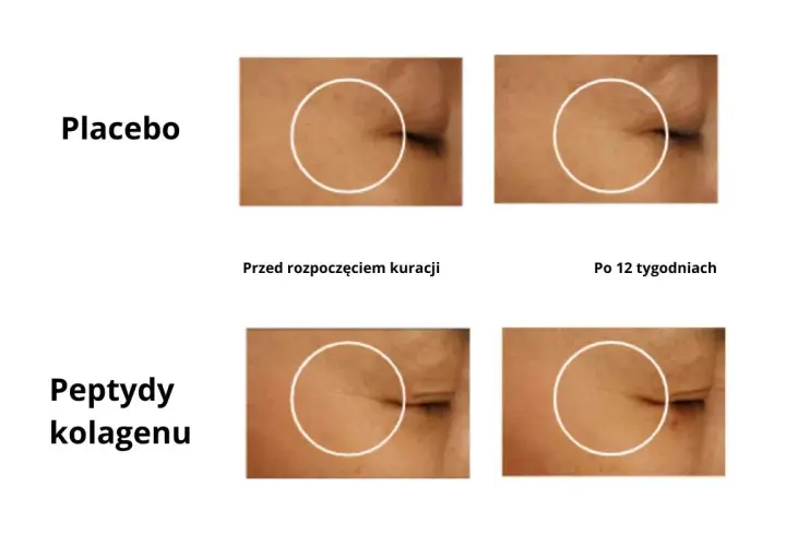 Porównanie skóry przed i po 12 tygodniach. Grupa placebo bez zmian, grupa z peptydami kolagenu wykazuje redukcję zmarszczek, co może być oznaką, że nadmiar kolagenu objawy nie są widoczne.